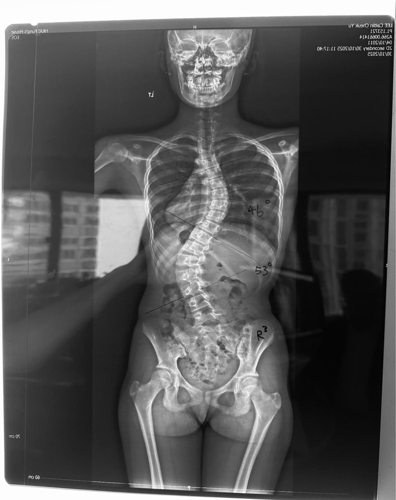 First patient with left lumbar right thoracic, right hip prominence