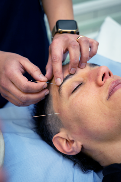 Acupuncture