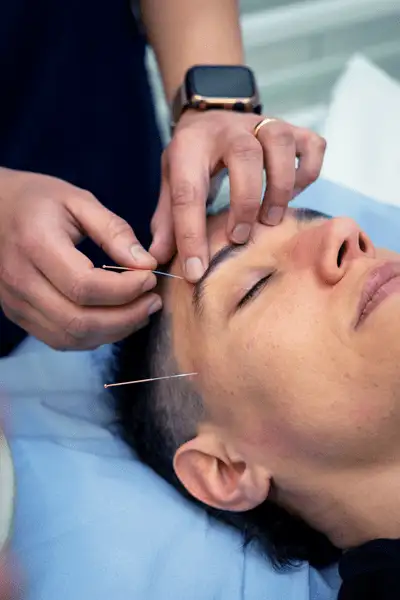 acupuncture