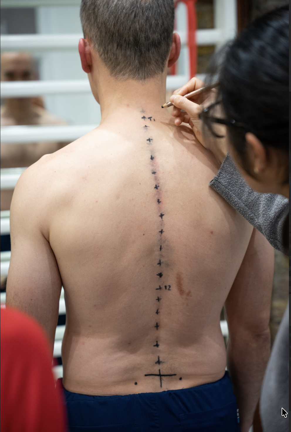 scoliosis